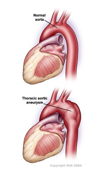 aortic aneurysm