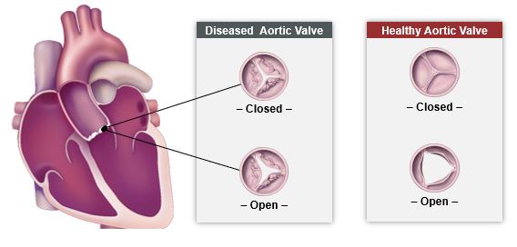 Aortic stenosis illustration